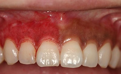 Dark Gums During Treatment