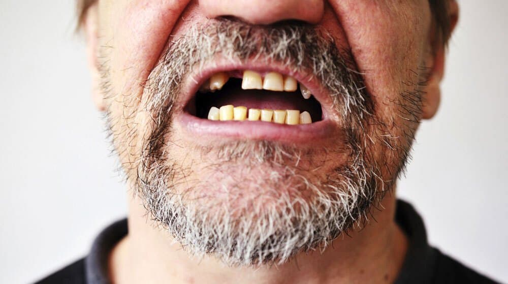 Man with missing teeth