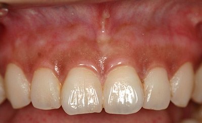 Dark Gums After
