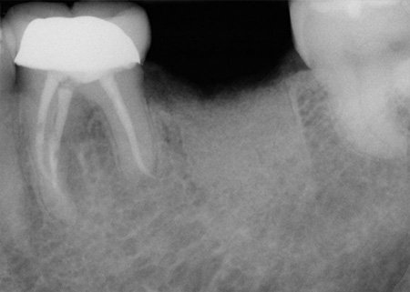 Fractured tooth extraction After