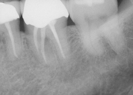 Fractured tooth extraction before