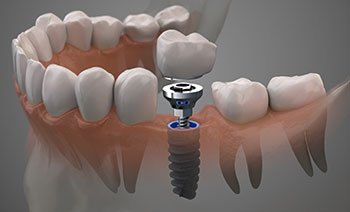 3-D model of a titanium dental implant